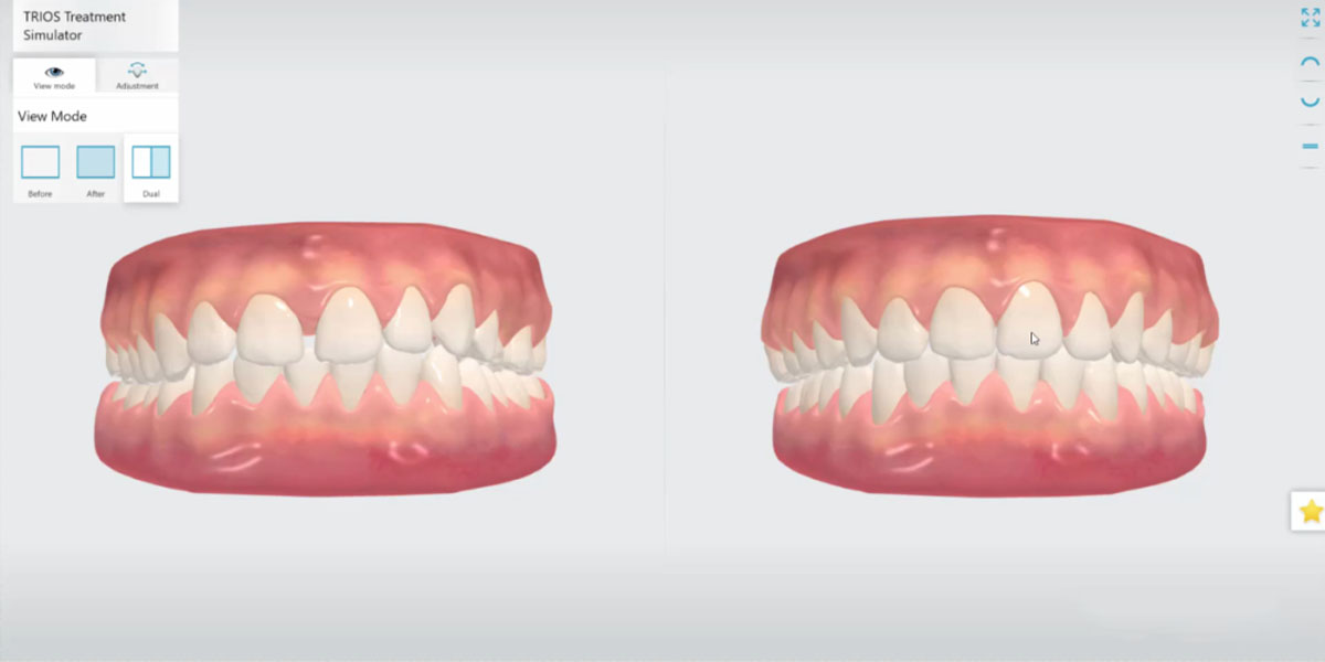 dental intraoral scanner comparison