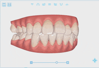 how to use intraoral scanner